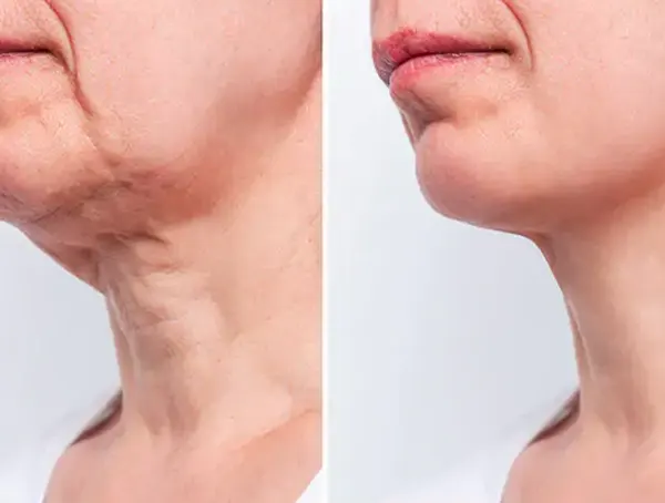 sculptra antes e depois do tratamento