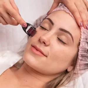 microagulhamento facial, corporal e capilar em Belo Horizonte