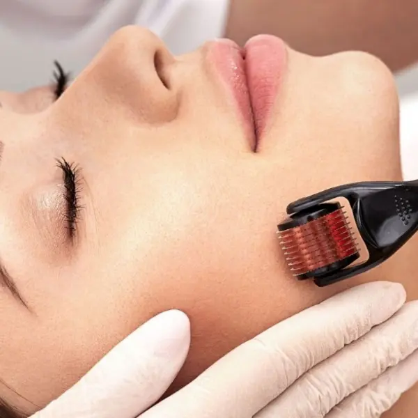 microagulhamento facial