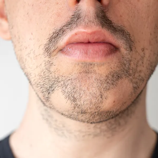alopécia areata na barba
