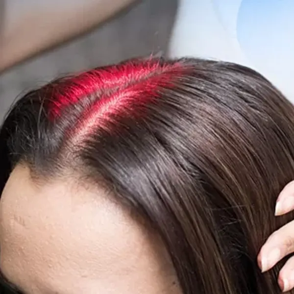 laser de baixa potência no tratamento da queda de cabelo
