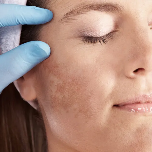 mesoterapia no tratamento de melasma em BH