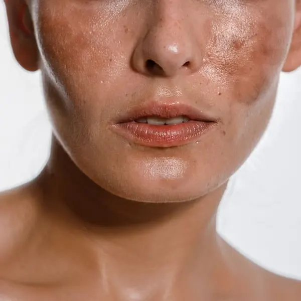 sintomas do melasma