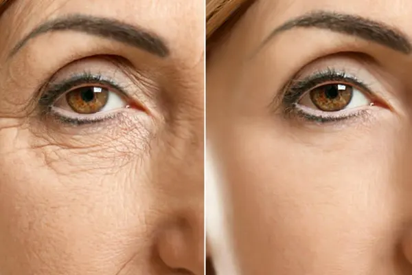 antes e depois do tratamento para rugas nos olhos