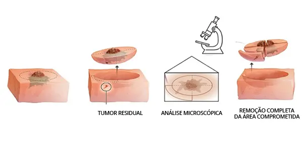 como é feita a cirurgia micrográfica de mohs