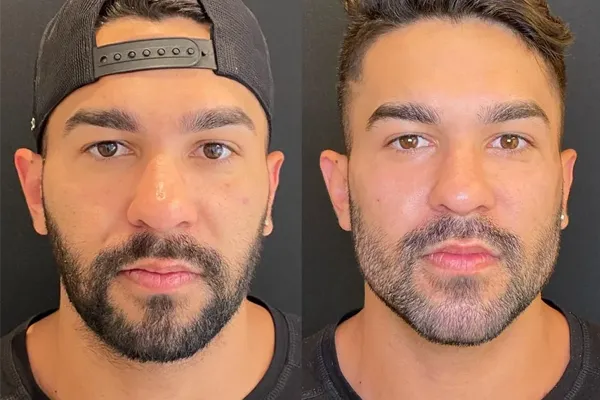 preenchimento de mandíbula antes e depois