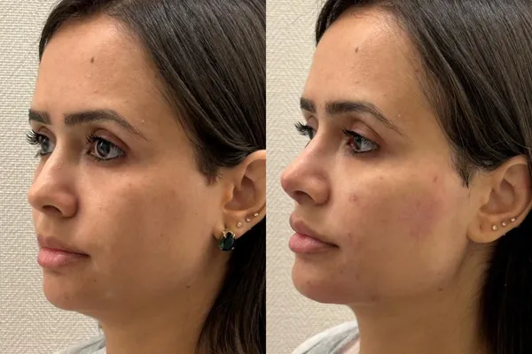 preenchimento de mandíbula em mulheres
