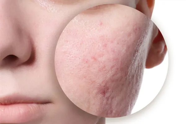 cicatrizes de acne