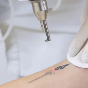 Remoção de tatuagem em Belo Horizonte