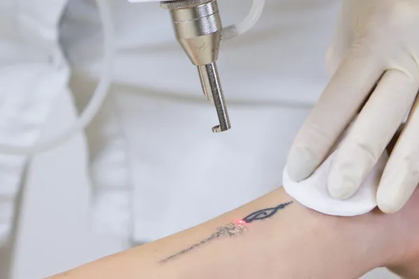 Remoção de tatuagem em Belo Horizonte