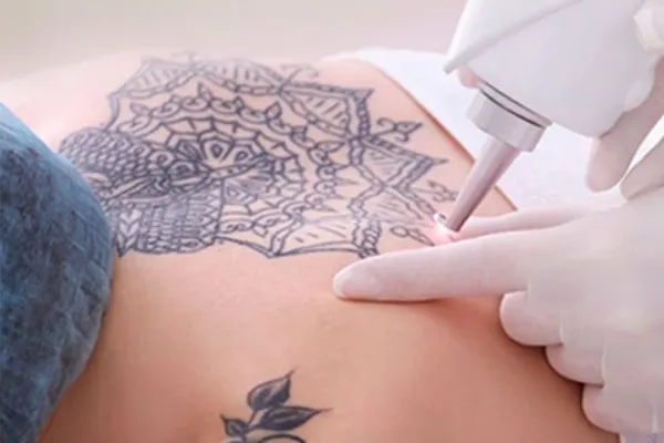 remover tatuagem em BH com laser
