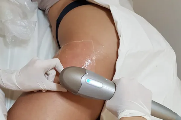 ultraformer no tratamento do lipedema