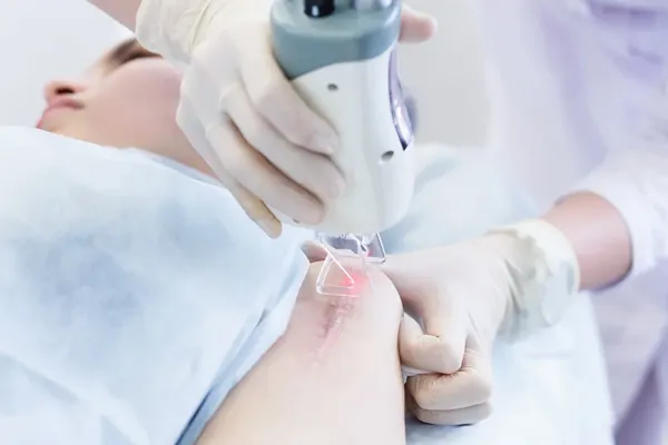 tratamento de quelóide a laser