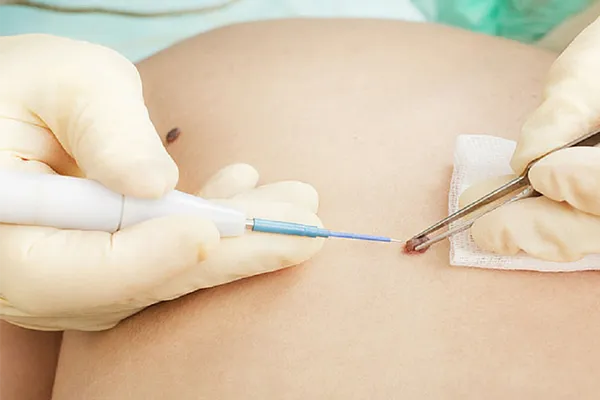 remoção de verruga em Belo Horizonte