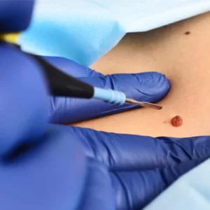 cirurgia dermatológica em BH