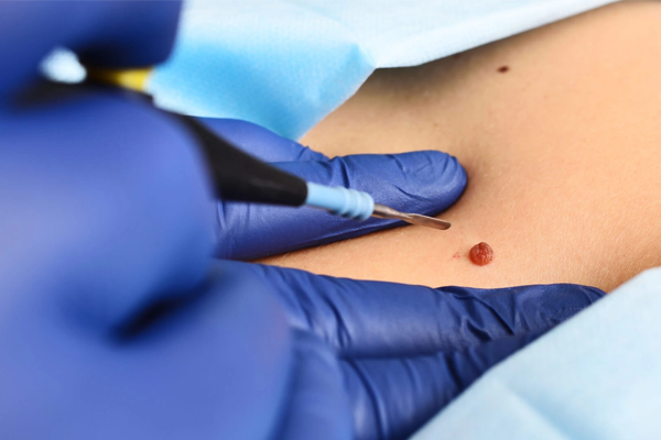 cirurgia dermatológica em BH