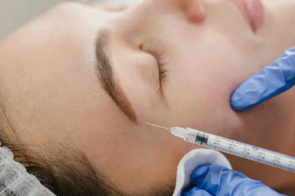 bioestimulador sculptra na sobrancelha