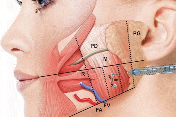 botox no tratamento do Bruxismo