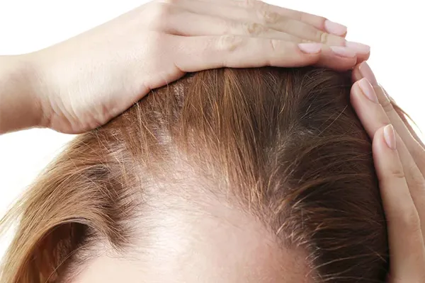 alopécia de tração e causas