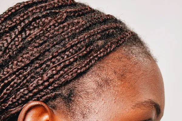 alopécia de tração causada por tranças e dreads