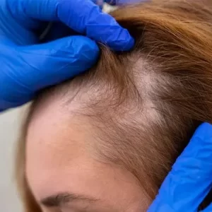 Alopécia de tração, sintomas e tratamentos