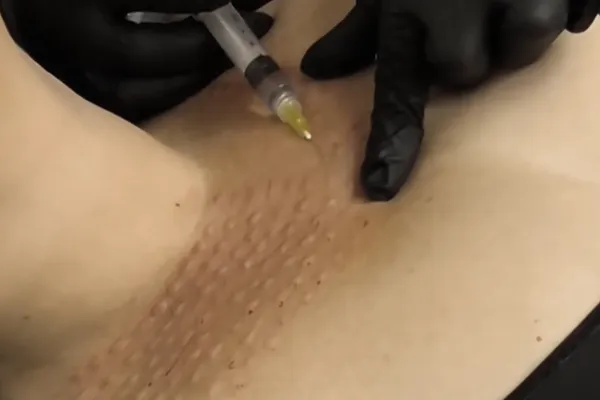 bioestimulador de colageno e skinbooster para flacidez e rugas no colo