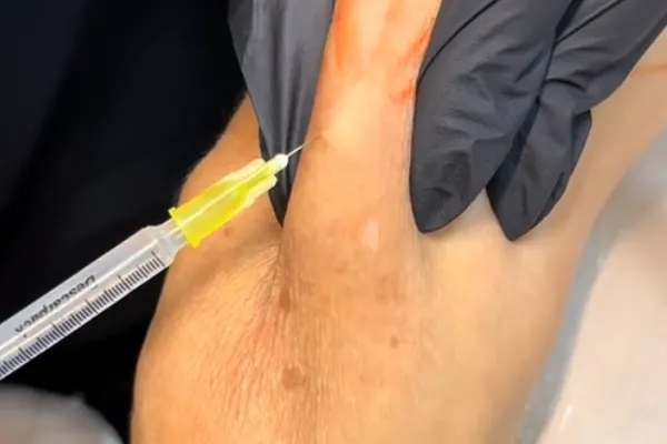 bioestimuladores para flacidez nos braços
