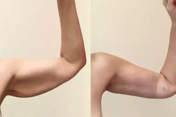flacidez nos braços antes e depois