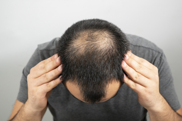 alopecia androgenetica