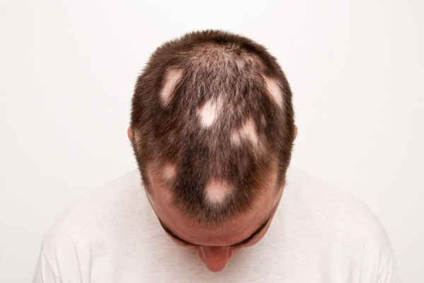 alopecia areata
