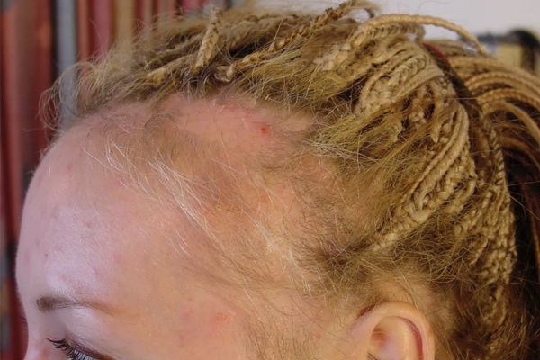 alopecia de tração