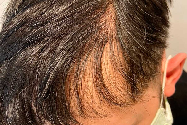 alopecia difusa
