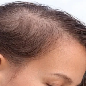 tratamento para alopecia difusa em Belo Horizonte