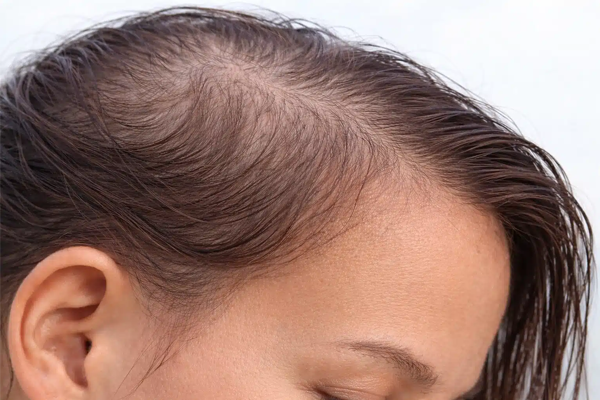 tratamento para alopecia difusa em Belo Horizonte