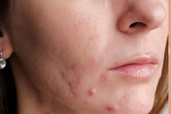 acne adulta