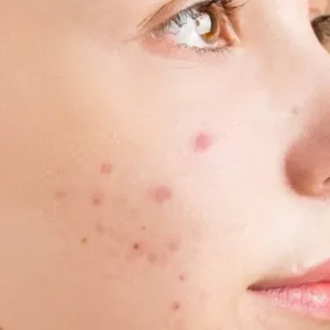 acne na adolescência
