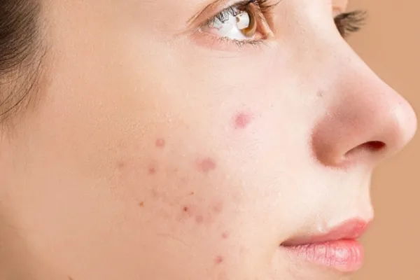 acne na adolescência