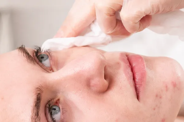 tratamento tópico para acne