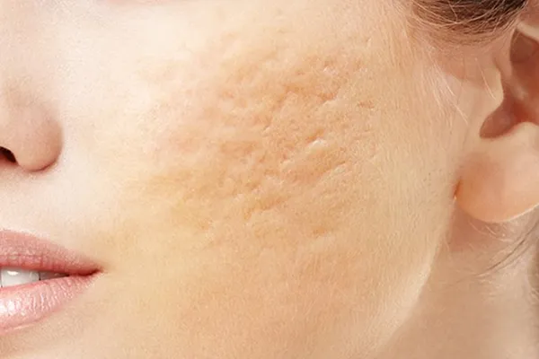 cicatrizes de acne