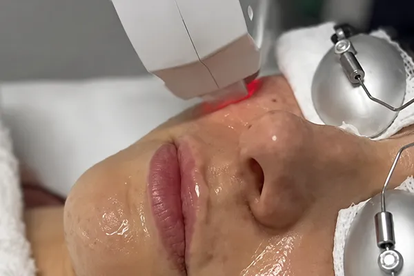 luz pulsada no tratamento da acne