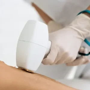 laser etherea-mx belo horizonte