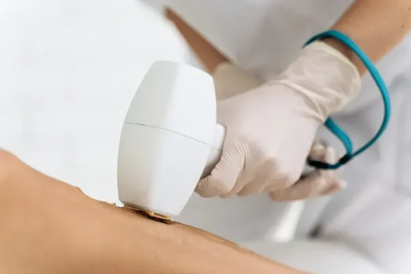 laser etherea-mx belo horizonte
