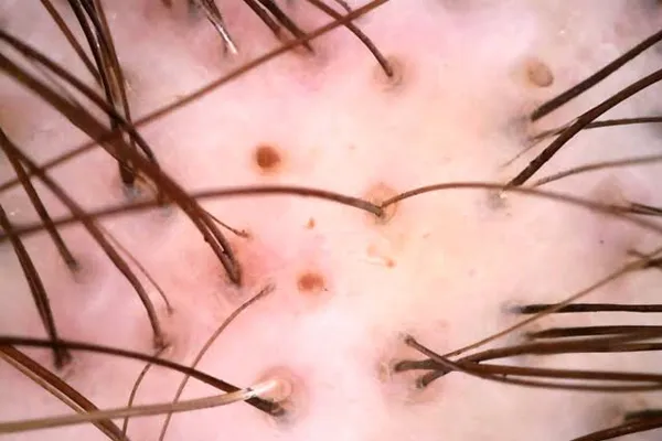 tricoscopia para diagnóstico de alopécias